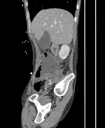 Collection around ileocolic anastomosis | Image | Radiopaedia.org