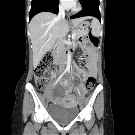 Pelvic collections after appendectomy | Image | Radiopaedia.org