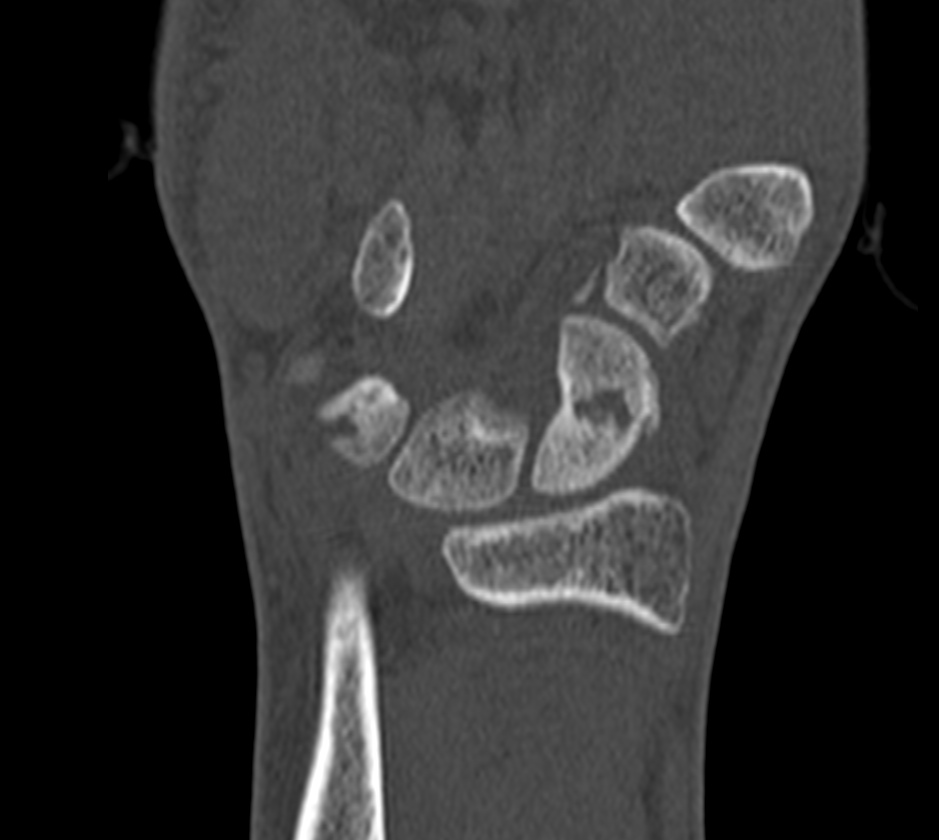 Delayed Healing In Scaphoid Fracture 