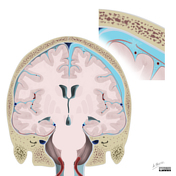 Subdural hygroma | Radiology Reference Article | Radiopaedia.org