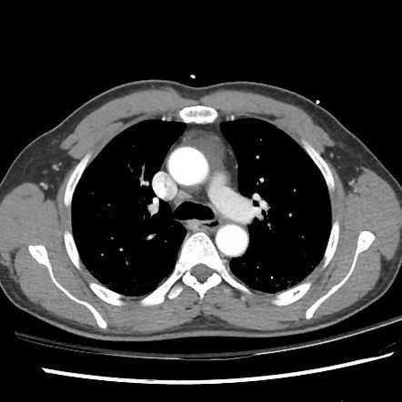 Prominent pericardial recess on trauma CT | Radiology Case ...