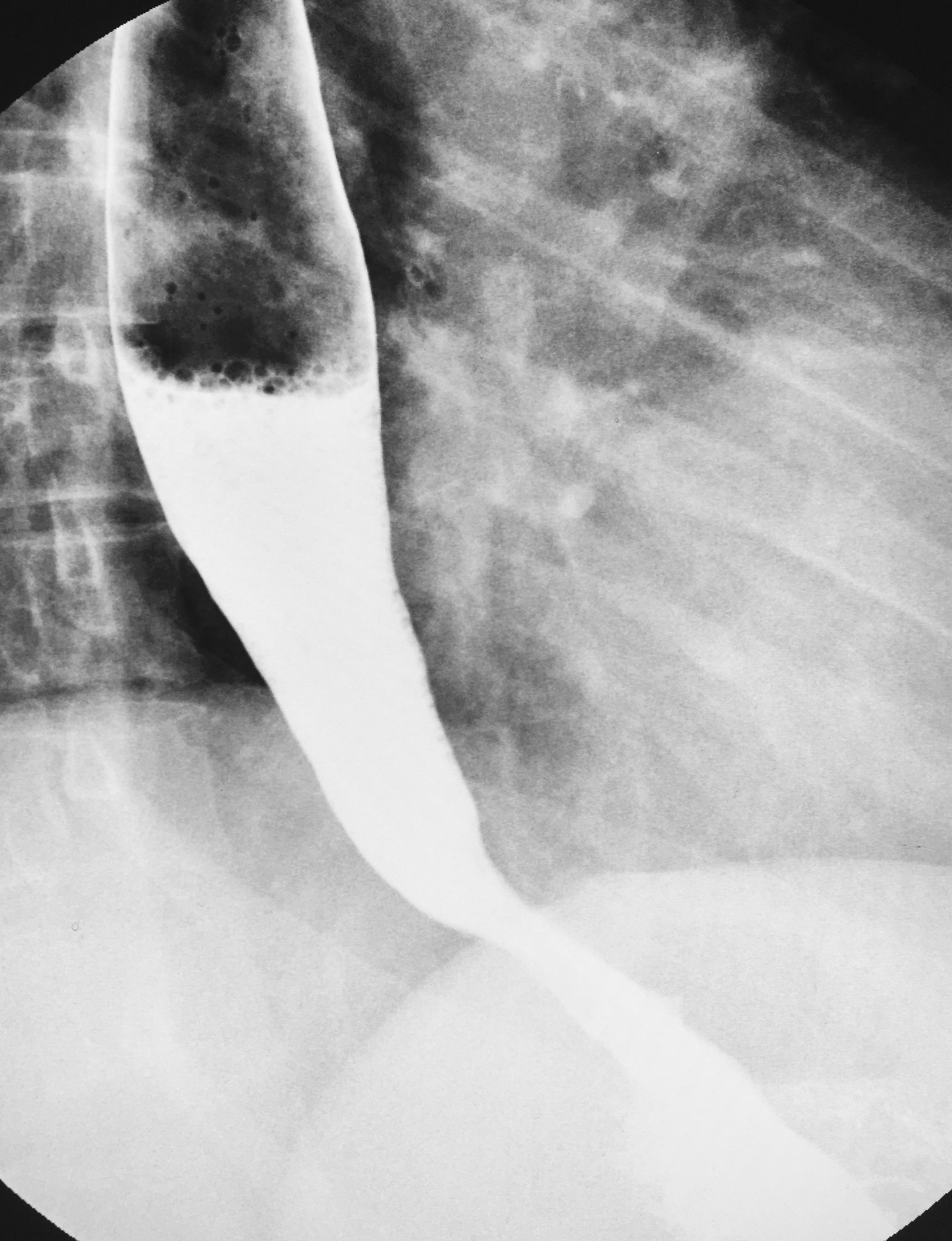 Normal barium swallow Image