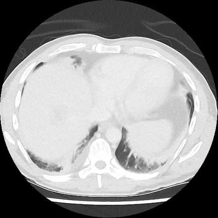 Amoebic liver abscesses | Image | Radiopaedia.org