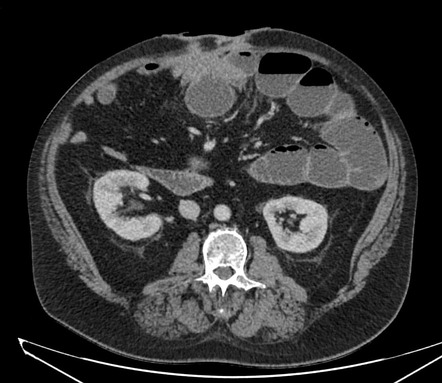 Small bowel obstruction due to tethering of bowel loops in Crohn ...