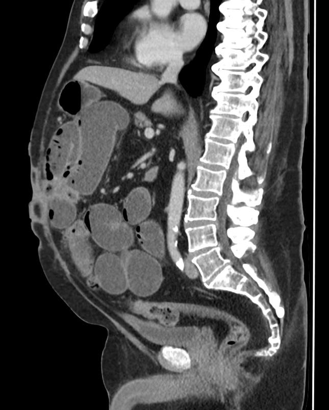 Small bowel obstruction due to tethering of bowel loops in Crohn ...