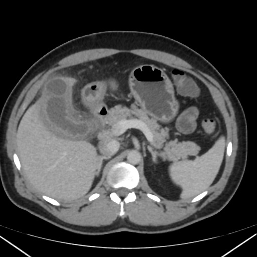 Acute on chronic calculous cholecystitis | Image | Radiopaedia.org