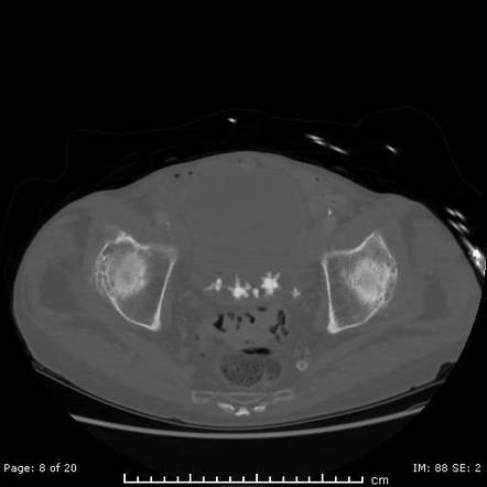 Jackstone calculus | Radiology Reference Article | Radiopaedia.org