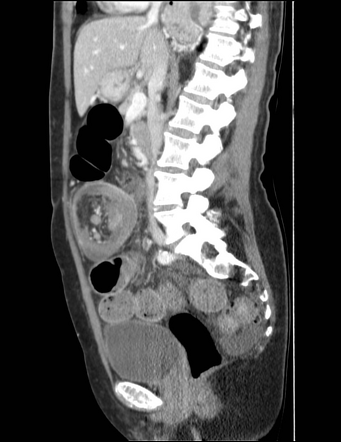 Ileocecal intussusception due to adenocarcinoma | Image | Radiopaedia.org