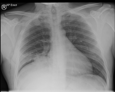 Right diaphragmatic injury initially missed | Radiology Case ...