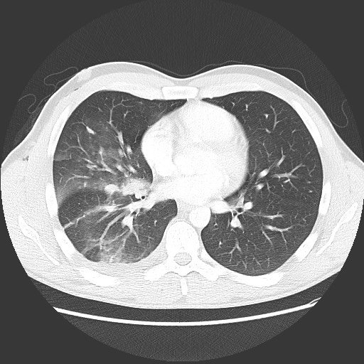 Right diaphragmatic injury initially missed | Image | Radiopaedia.org