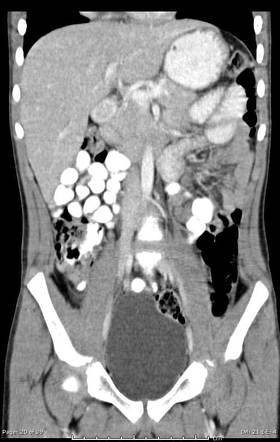 Agenesis of the gallbladder | Radiology Case | Radiopaedia.org