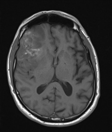 Oligodendroglioma (grade 3) | Radiology Case | Radiopaedia.org