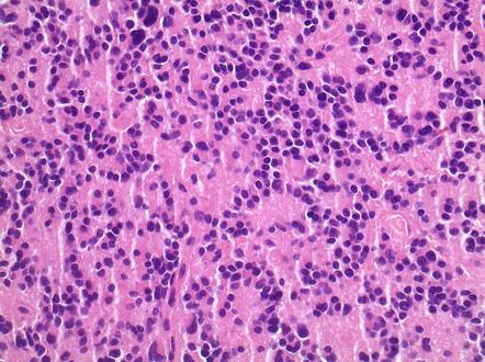 Pineocytoma | Image | Radiopaedia.org