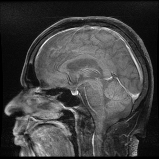 Marchiafava Bignami disease | Image | Radiopaedia.org