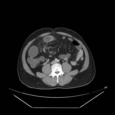 Ileoileal fistula (Crohn disease) | Image | Radiopaedia.org