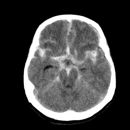 Investigating severe headache (summary) | Radiology Reference Article ...