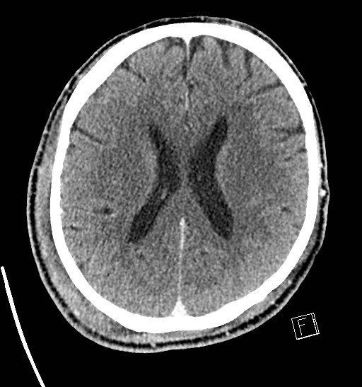 Hominick Hematoma