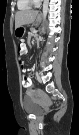 Ruptured corpus luteal cyst | Image | Radiopaedia.org