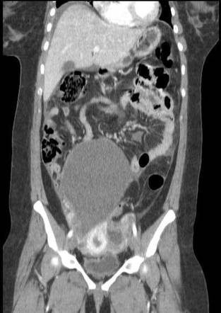 Endometriotic cyst with omental endometriosis | Radiology Case ...