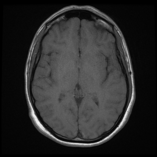 Oligodendroglioma | Image | Radiopaedia.org