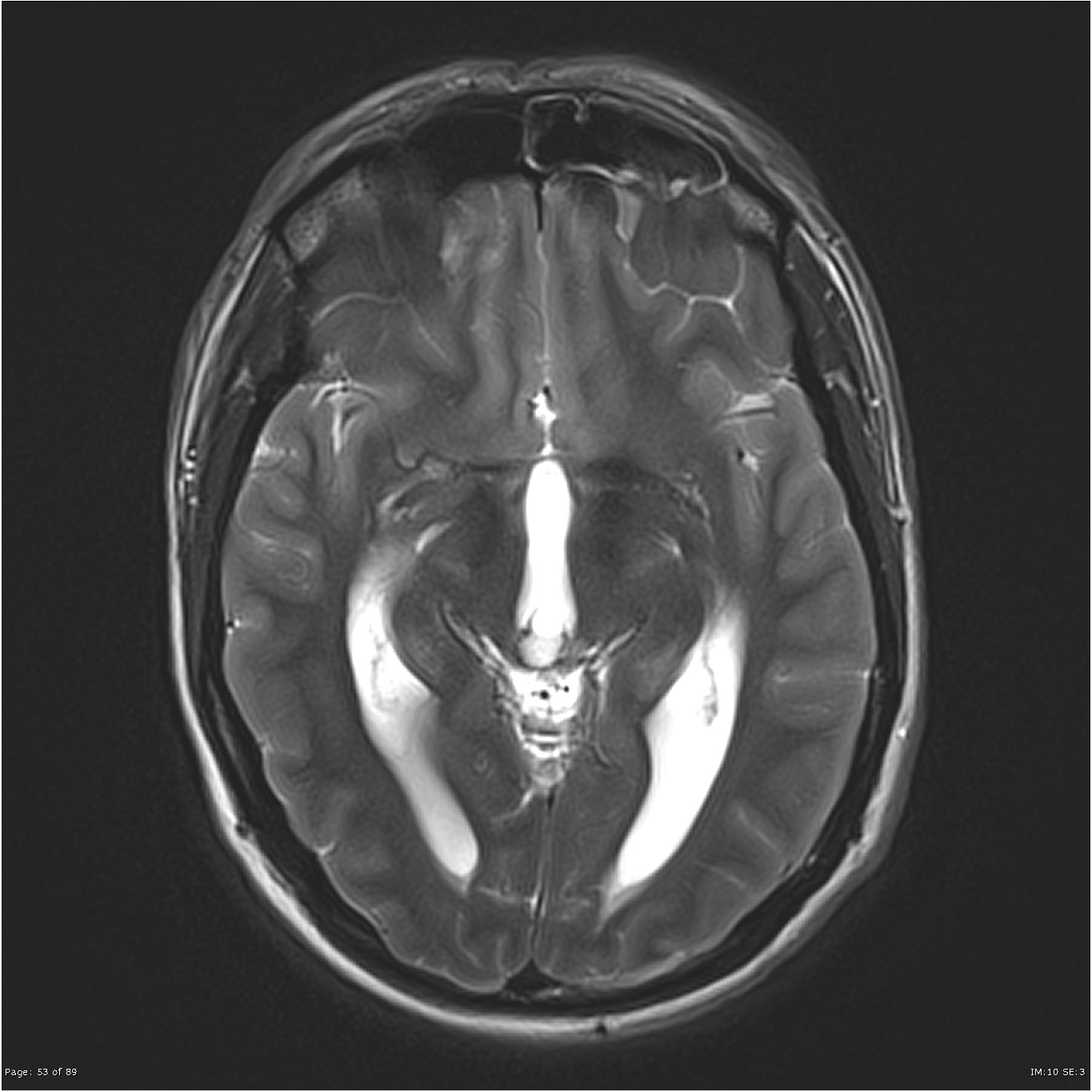 Pineal Cyst Obstructing Aqueduct Image