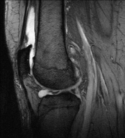 Meniscal Tear With Parameniscal Cyst Radiology Case Radiopaedia Org