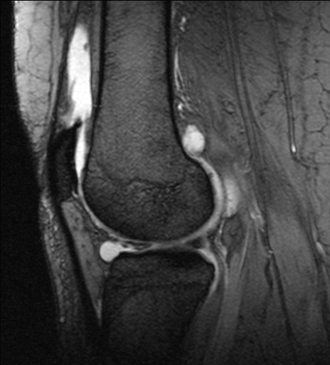 Meniscal tear with parameniscal cyst | Image | Radiopaedia.org