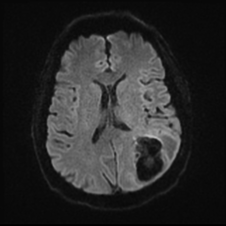 Early and late subacute intracerebral hemorrhage on MRI and CT | Image ...