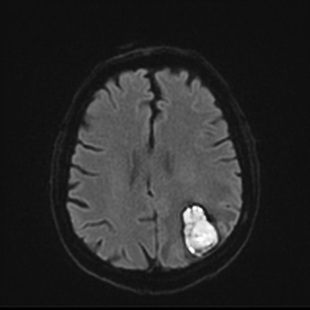 Early and late subacute intracerebral hemorrhage on MRI and CT | Image ...