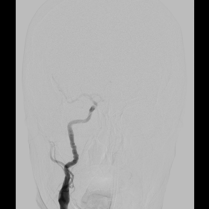 Reversible cerebral vasoconstriction syndrome (RCVS) with associated ...