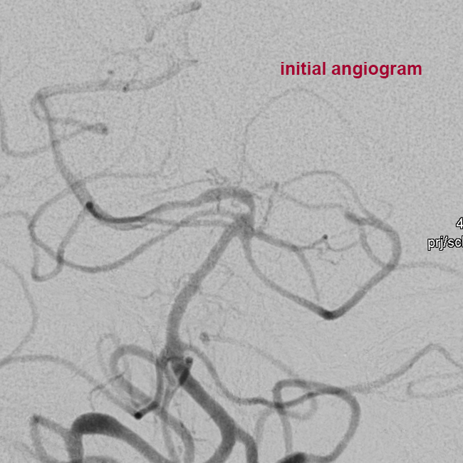 Reversible Cerebral Vasoconstriction Syndrome Rcvs With Associated