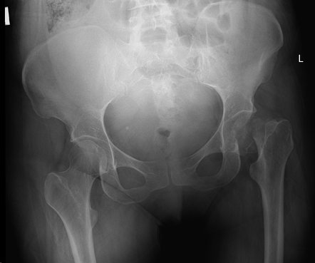 Transient osteoporosis of the hip | Radiology Reference Article ...