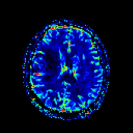 Anaplastic astroblastoma | Image | Radiopaedia.org