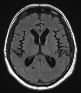 Spinal low grade chondrosarcoma | Image | Radiopaedia.org