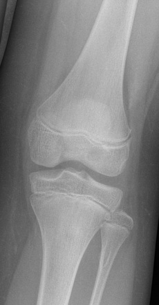 Sinding-Larsen-Johansson disease | Radiology Case | Radiopaedia.org