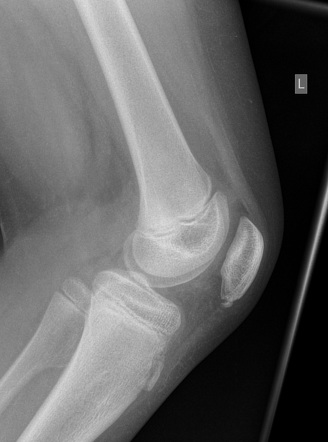 Sinding-Larsen-Johansson disease | Radiology Reference Article