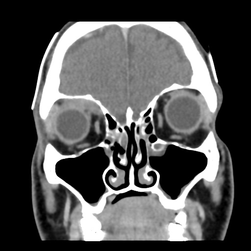 Orbital pseudotumor | Image | Radiopaedia.org