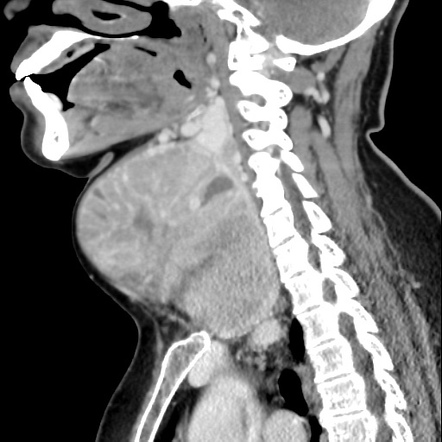 Multinodular Goiter Radiology Reference Article Radiopaedia Org