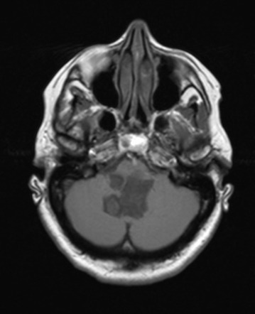 Epidermoid cyst (4th ventricle) | Image | Radiopaedia.org