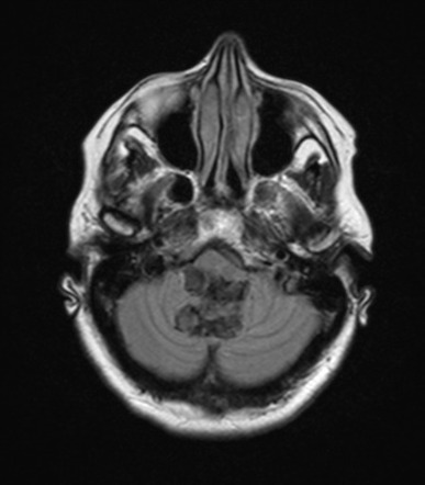 Epidermoid cyst (4th ventricle) | Image | Radiopaedia.org