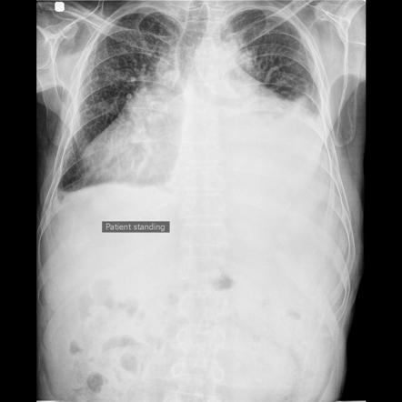 Cardiomegaly with bilateral pleural effusion | Radiology Case ...