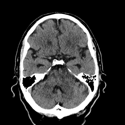 Acoustic schwannoma | Image | Radiopaedia.org