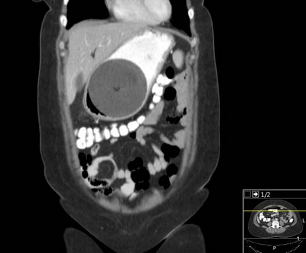 Intragastric Balloon 