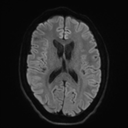 Huntington disease | Radiology Case | Radiopaedia.org