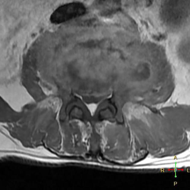 Spondylodiscitis | Radiology Reference Article | Radiopaedia.org