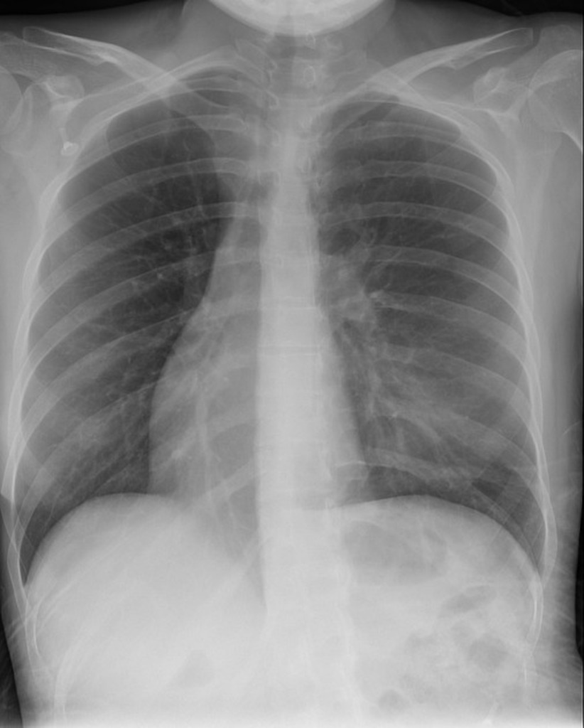 Dextrocardia Radiology Case Radiopaedia Org