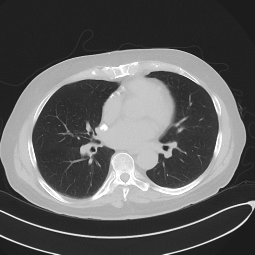 Migrated sternotomy wire | Image | Radiopaedia.org