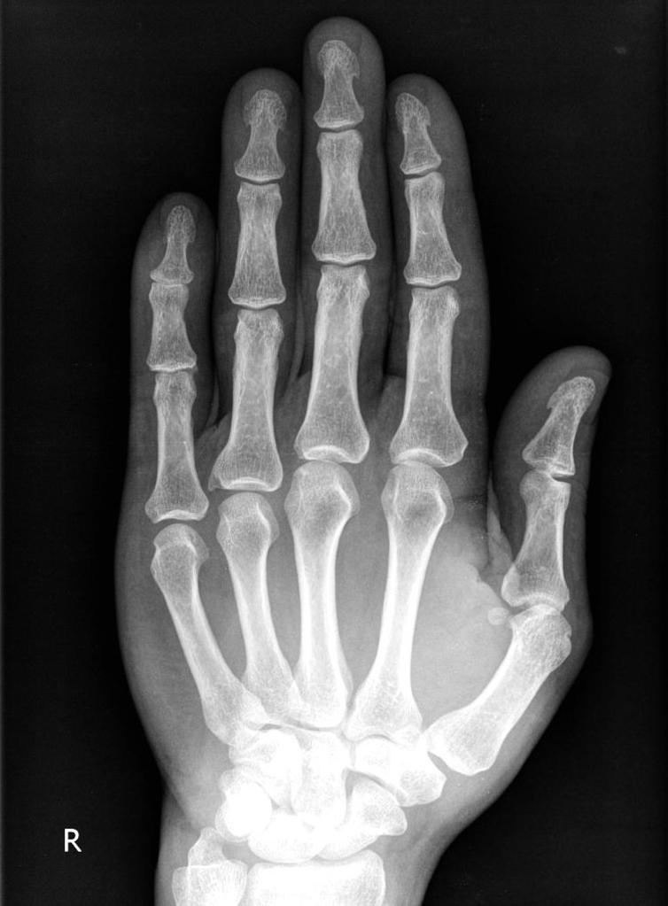 Broken Middle Finger X Ray