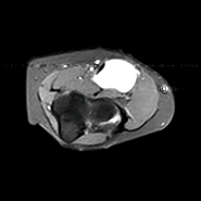 Bicipital radial bursitis | Image | Radiopaedia.org