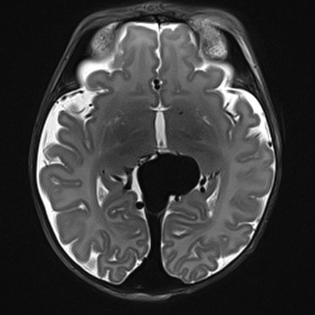 Vein of Galen malformation | Image | Radiopaedia.org